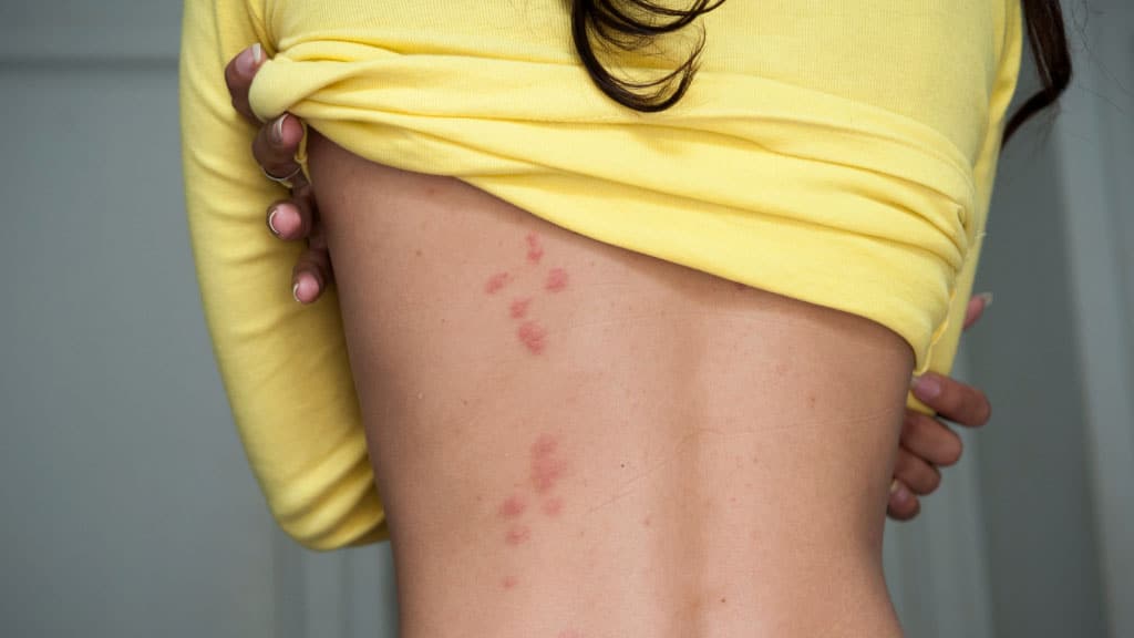 woman lifting up her yellow shirt to reveal large red welts on back indicating bug bites