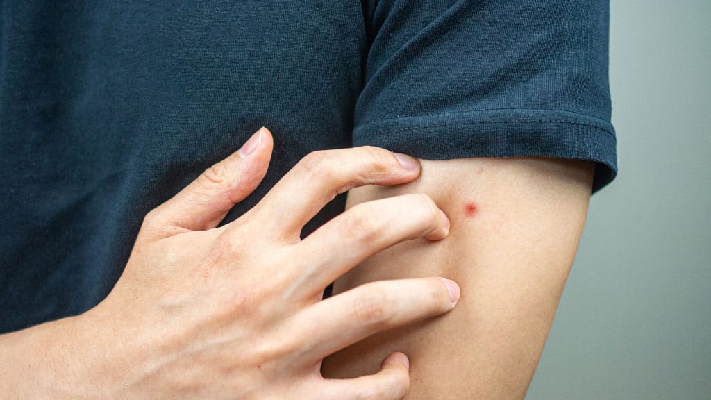 person touching arm with red spot indicating a spider bite