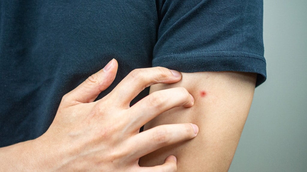 Brown recluse spider bite on left arm
