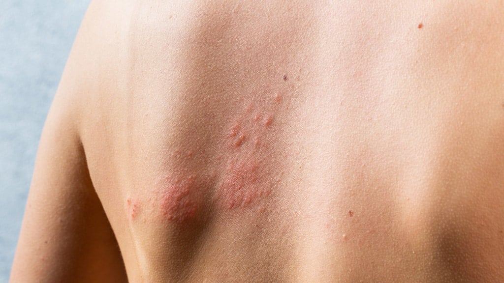 Bedbug bits on the back of a person