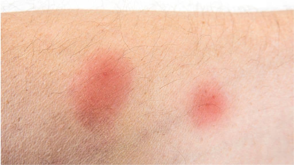 Flea Bites
