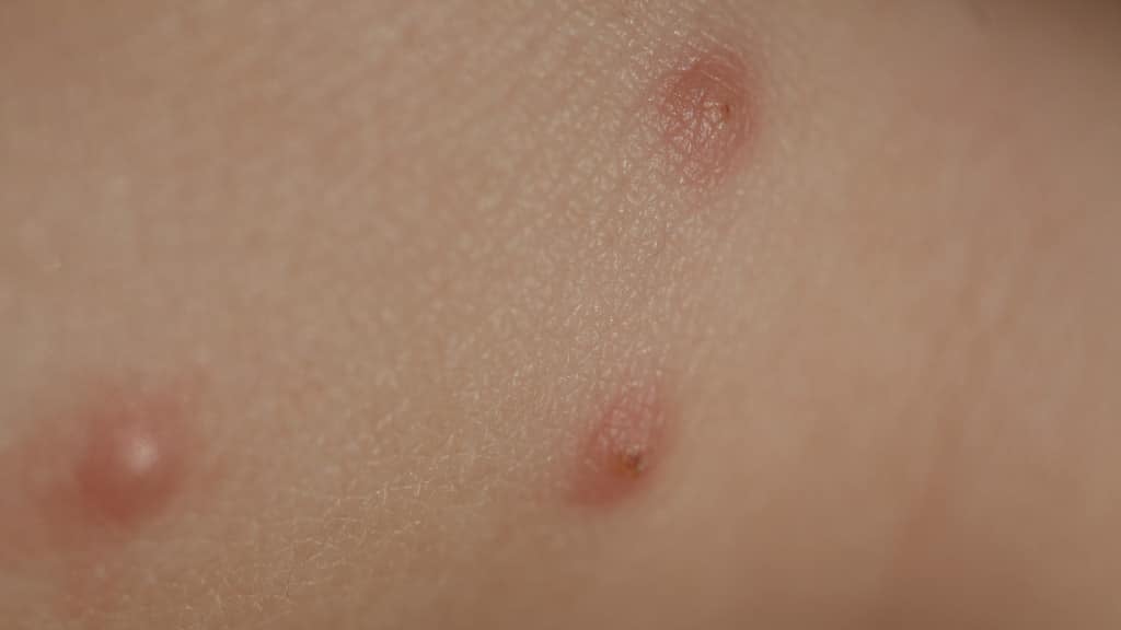 Bedbugs