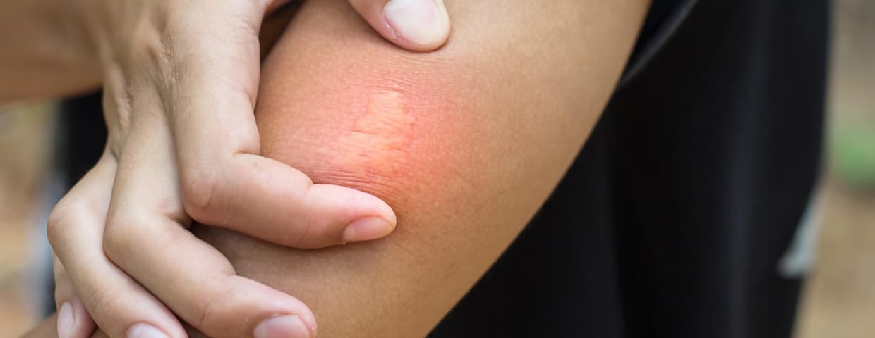 The Truth About Pest Allergies