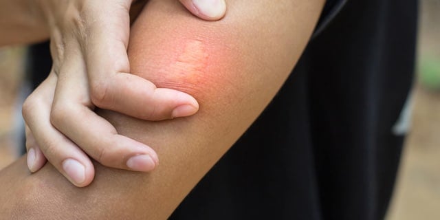 The Truth About Pest Allergies